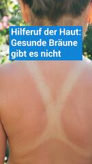 Warum es eine gesunde Bräune der Haut nicht gibt