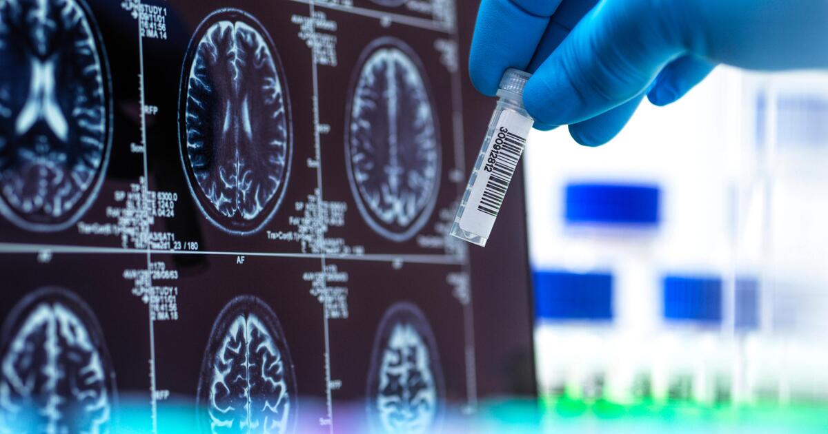 Erstmals Medikament Gegen Alzheimer In Der Frühphase Verfügbar - vi9db3g