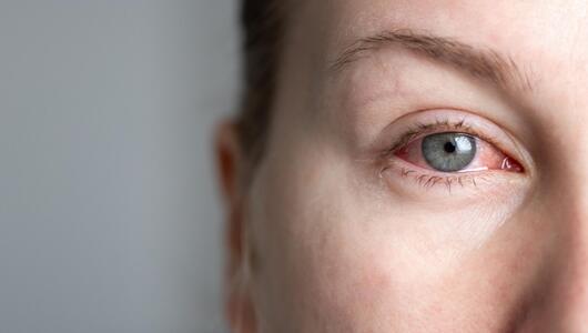 Frau mit gerötetem Auge