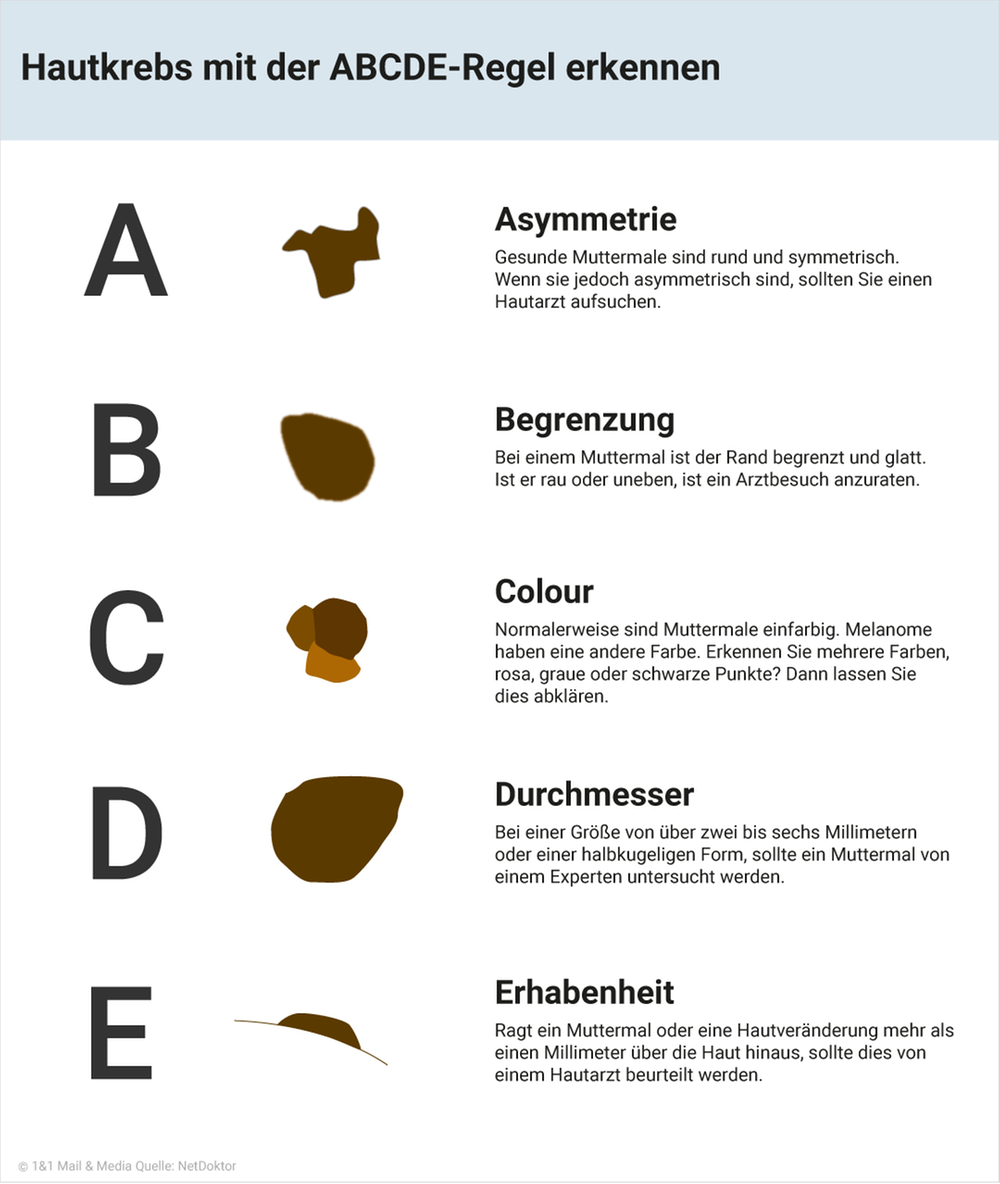 Hautkrebs mit der ABCDE-Regel erkennen