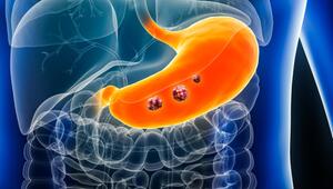 Illustration vom Magen mit Tumor