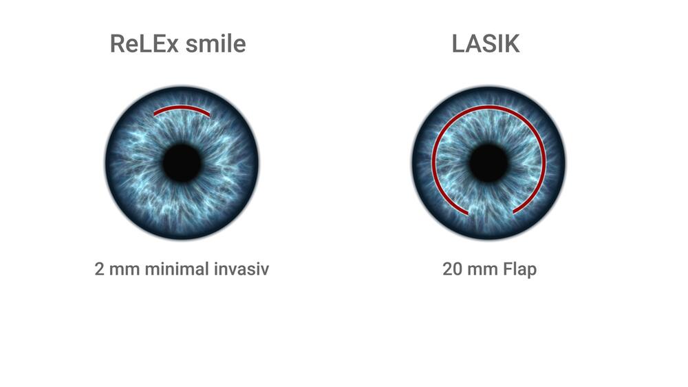 Der Unterschied zwischen zwei Augenlasermethoden: ReLEx smile und LASIK.