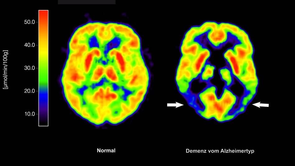 Alzheimer-Erkrankung